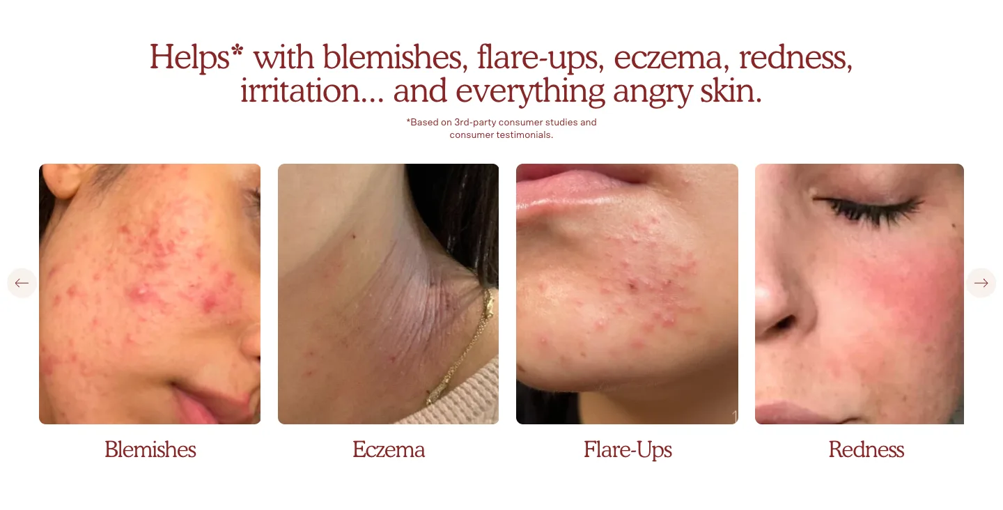 Helps* with blemishes, flare-ups, eczema, redness, irritation... and everything angry skin. from Tower 28 Beauty